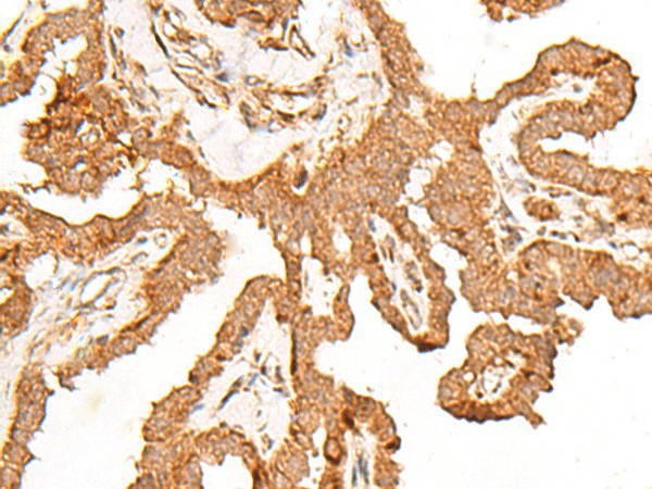 Immunohistochemistry of paraffin-embedded Human thyroid cancer tissue  using FER Polyclonal Antibody at dilution of 1:80(?200)