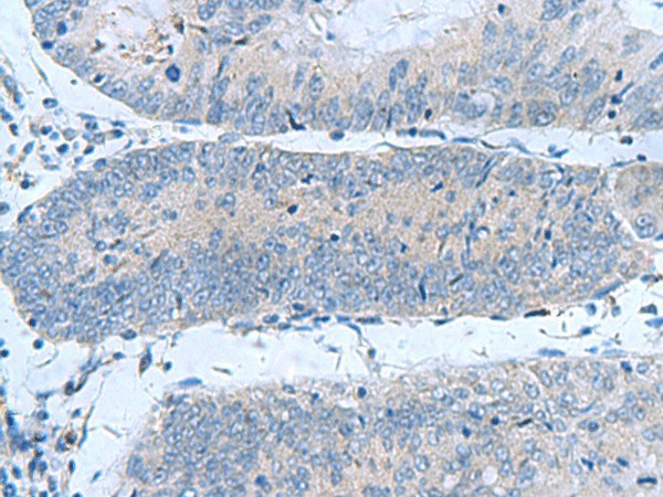 Immunohistochemistry of paraffin-embedded Human colorectal cancer tissue  using GUCA1A Polyclonal Antibody at dilution of 1:50(?200)