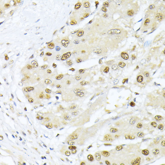 Immunohistochemistry of paraffin-embedded Human liver cancer using PCNA Polyclonal Antibody at dilution of  1:100 (40x lens).