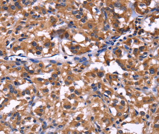 Immunohistochemistry of paraffin-embedded Human thyroid cancer tissue using SELPLG Polyclonal Antibody at dilution 1:50