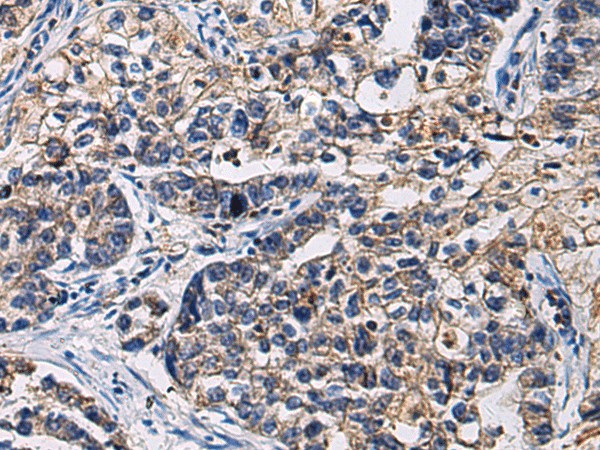 Immunohistochemistry of paraffin-embedded Human gastric cancer tissue  using SSH3 Polyclonal Antibody at dilution of 1:55(?200)