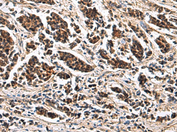 Immunohistochemistry of paraffin-embedded Human breast cancer tissue  using ARPC1B Polyclonal Antibody at dilution of 1:65(?200)