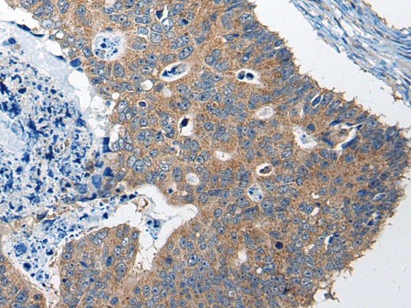 Immunohistochemistry of paraffin-embedded Human colorectal cancer tissue  using RTN4IP1 Polyclonal Antibody at dilution of 1:50(?200)