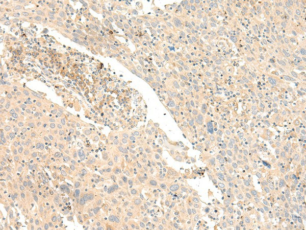 Immunohistochemistry of paraffin-embedded Human cervical cancer tissue  using GLIS1 Polyclonal Antibody at dilution of 1:40(?200)