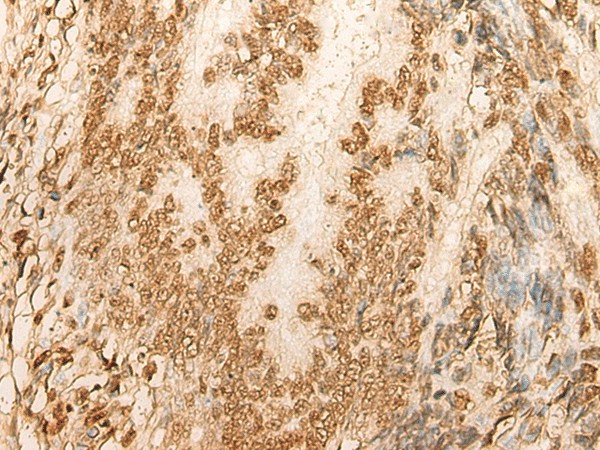 Immunohistochemistry of paraffin-embedded Human colorectal cancer tissue  using HIST1H2BA Polyclonal Antibody at dilution of 1:45(?200)