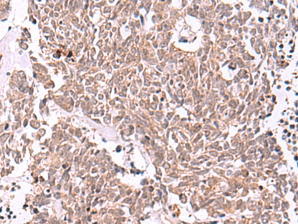 Immunohistochemistry of paraffin-embedded Human lung cancer tissue  using IRX4 Polyclonal Antibody at dilution of 1:40(?200)