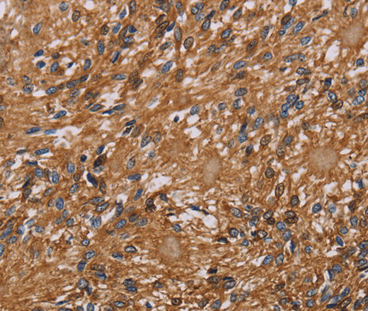 Immunohistochemistry of paraffin-embedded Human ovarian cancer tissue using HYAL2 Polyclonal Antibody at dilution 1:40