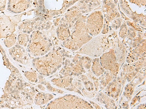 Immunohistochemistry of paraffin-embedded Human thyroid cancer tissue  using GOLGA7 Polyclonal Antibody at dilution of 1:40(?200)