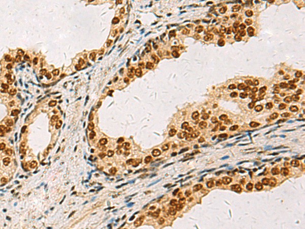 Immunohistochemistry of paraffin-embedded Human prost ate cancer tissue  using ELF5 Polyclonal Antibody at dilution of 1:75(?200)