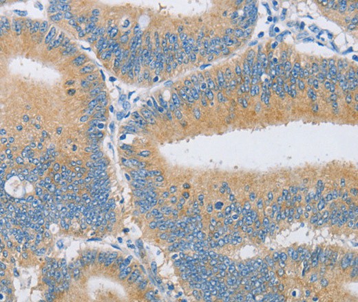 Immunohistochemistry of paraffin-embedded Human colon cancer tissue using CENPE Polyclonal Antibody at dilution 1:50