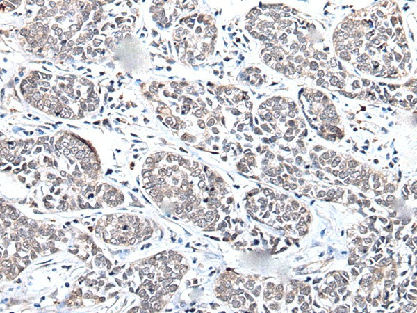 Immunohistochemistry of paraffin-embedded Human esophagus cancer tissue  using BRMS1L Polyclonal Antibody at dilution of 1:45(?200)