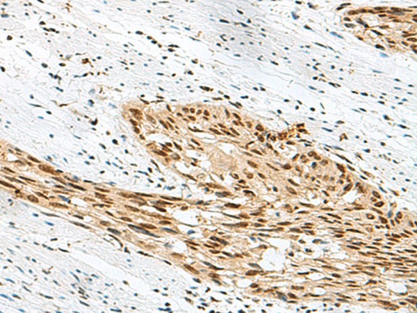 Immunohistochemistry of paraffin-embedded Human esophagus cancer tissue  using RBM12 Polyclonal Antibody at dilution of 1:50(?200)