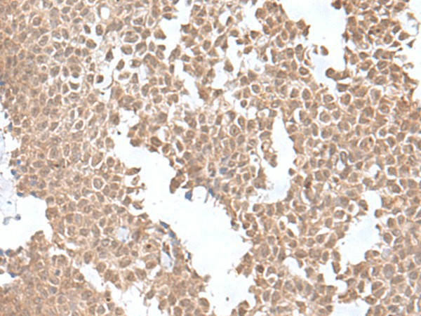 Immunohistochemistry of paraffin-embedded Human ovarian cancer tissue  using SNRNP25 Polyclonal Antibody at dilution of 1:55(?200)