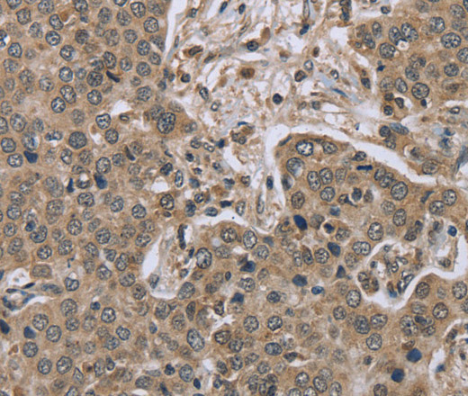 Immunohistochemistry of paraffin-embedded Human liver cancer tissue using IL15RA Polyclonal Antibody at dilution 1:45