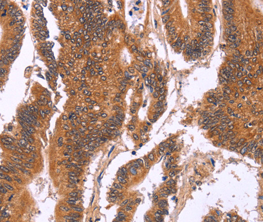 Immunohistochemistry of paraffin-embedded Human colon cancer tissue using CDC37L1 Polyclonal Antibody at dilution 1:60