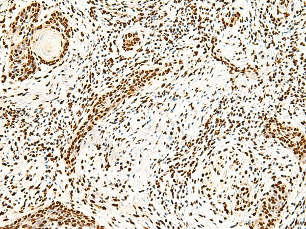 Immunohistochemistry of paraffin-embedded Human esophagus cancer tissue  using ILF3 Polyclonal Antibody at dilution of 1:40(?200)