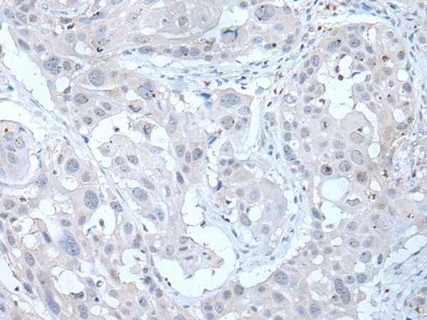 Immunohistochemistry of paraffin-embedded Human esophagus cancer tissue  using ANGPTL6 Polyclonal Antibody at dilution of 1:55(?200)