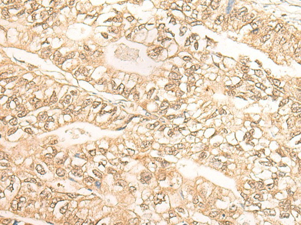 Immunohistochemistry of paraffin-embedded Human gastric cancer tissue  using DMC1 Polyclonal Antibody at dilution of 1:30(?200)