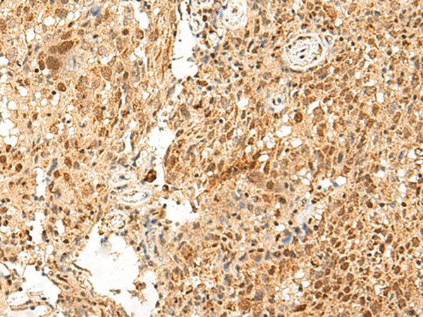 Immunohistochemistry of paraffin-embedded Human cervical cancer tissue  using PAF1 Polyclonal Antibody at dilution of 1:55(?200)