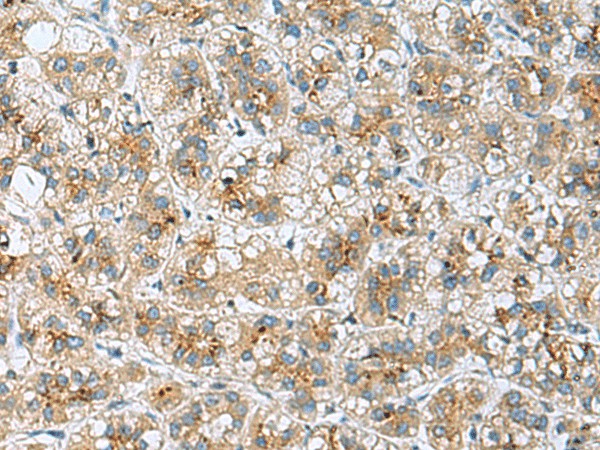 Immunohistochemistry of paraffin-embedded Human liver cancer tissue  using TMED10 Polyclonal Antibody at dilution of 1:50(?200)