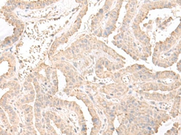 Immunohistochemistry of paraffin-embedded Human thyroid cancer tissue  using ERGIC3 Polyclonal Antibody at dilution of 1:50(?200)