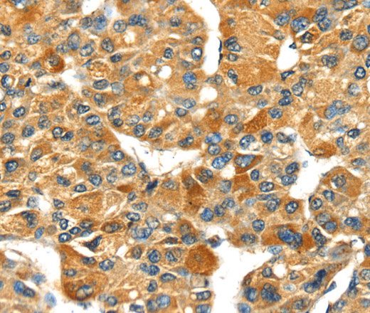 Immunohistochemistry of paraffin-embedded Human liver cancer using SPARC Polyclonal Antibody at dilution of 1:35