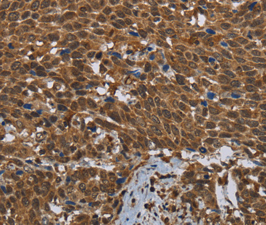 Immunohistochemistry of paraffin-embedded Human cervical cancer tissue using GCK Polyclonal Antibody at dilution 1:60