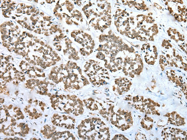 Immunohistochemistry of paraffin-embedded Human esophagus cancer tissue  using ZNF486 Polyclonal Antibody at dilution of 1:50(?200)