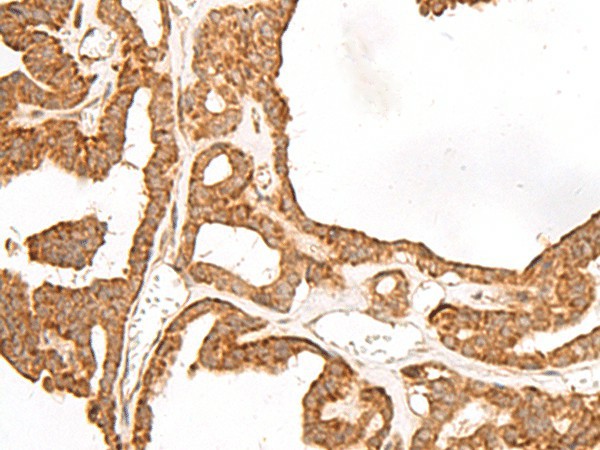 Immunohistochemistry of paraffin-embedded Human thyroid cancer tissue  using GBGT1 Polyclonal Antibody at dilution of 1:40(?200)