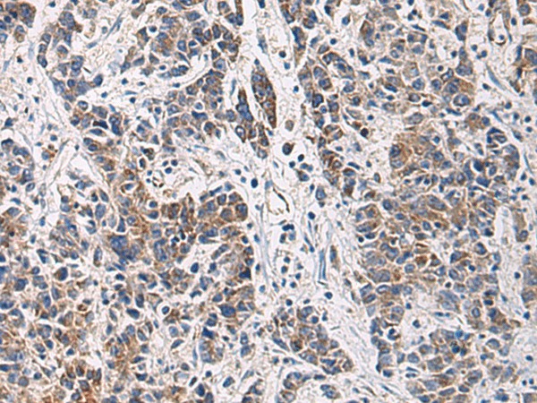 Immunohistochemistry of paraffin-embedded Human colorectal cancer tissue  using HSDL2 Polyclonal Antibody at dilution of 1:80(?200)