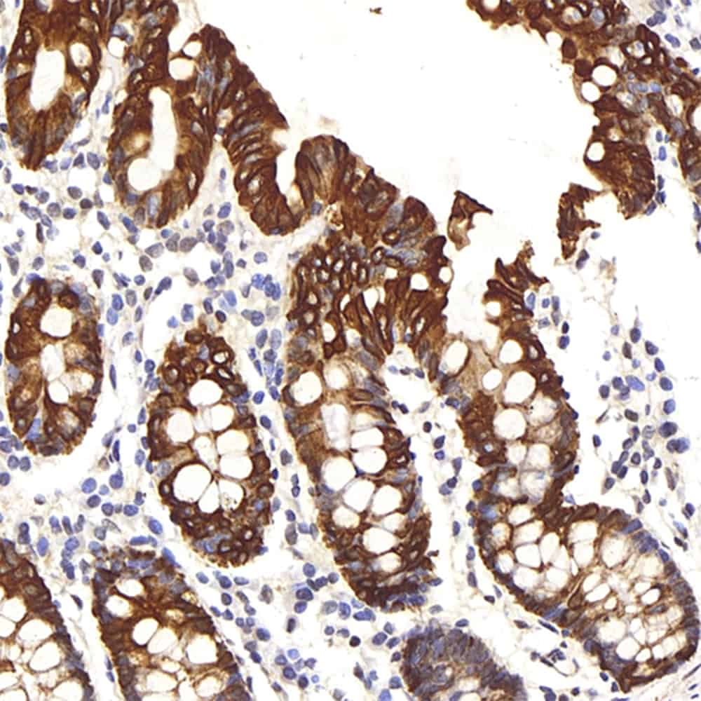 Immunohistochemistry analysis of paraffin-embedded human colon  using CK-8 Polyclonal Antibody at dilution of 1:200.