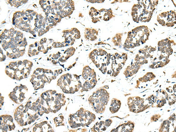 Immunohistochemistry of paraffin-embedded Human esophagus cancer tissue  using EEF1E1 Polyclonal Antibody at dilution of 1:35(?200)