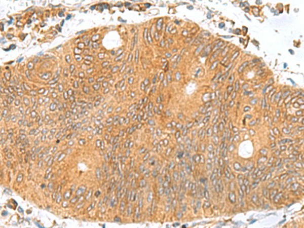 Immunohistochemistry of paraffin-embedded Human colorectal cancer tissue  using TXNDC12 Polyclonal Antibody at dilution of 1:70(?200)