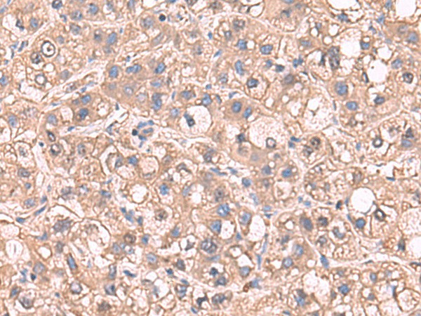 Immunohistochemistry of paraffin-embedded Human liver cancer tissue  using SARS Polyclonal Antibody at dilution of 1:65(?200)