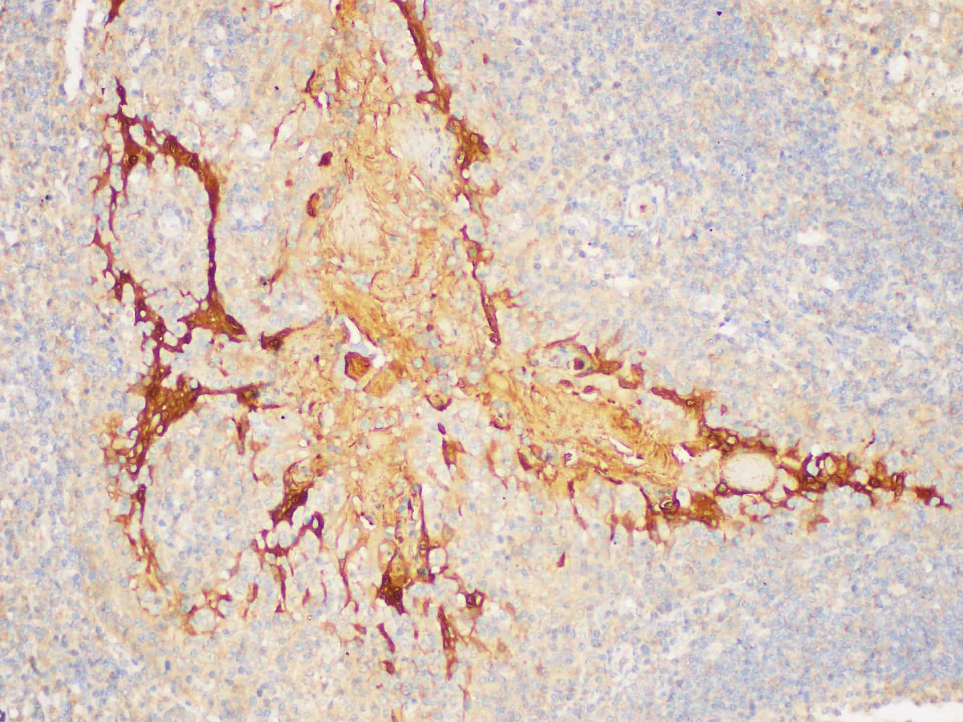 Immunohistochemistry of paraffin-embedded Human tonsil using SERPINB2 Polycloanl Antibody at dilution of 1:200