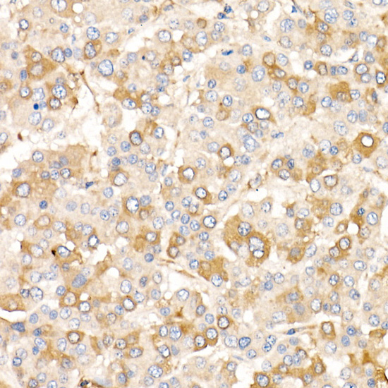 Immunohistochemistry of paraffin-embedded human liver cancer using AIFM2/AMID/AMID/AMID Polyclonal Antibody at dilution of 1:20 (40x lens).Perform high pressure antigen retrieval with 10 mM citrate buffer pH 6.0 before commencing with IHC staining protoco