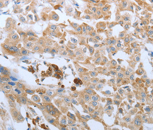 Immunohistochemistry of paraffin-embedded Human lung cancer tissue using FGF1 Polyclonal Antibody at dilution 1:50