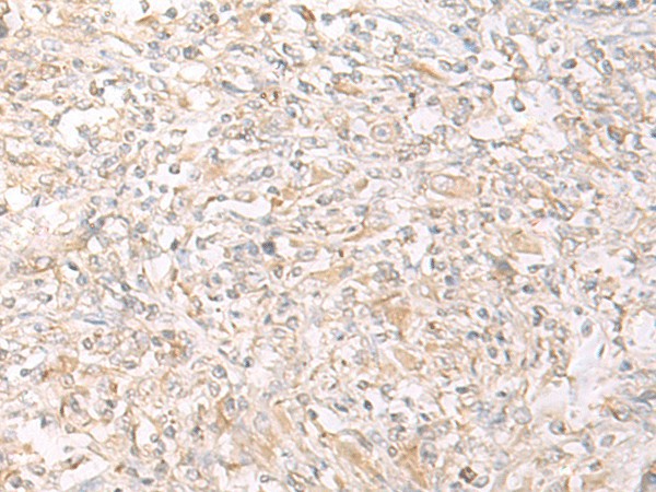 Immunohistochemistry of paraffin-embedded Human liver cancer tissue  using IL12B Polyclonal Antibody at dilution of 1:45(?200)