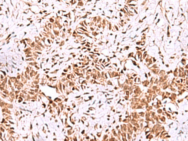 Immunohistochemistry of paraffin-embedded Human ovarian cancer tissue  using ISY1-RAB43 Polyclonal Antibody at dilution of 1:55(?200)