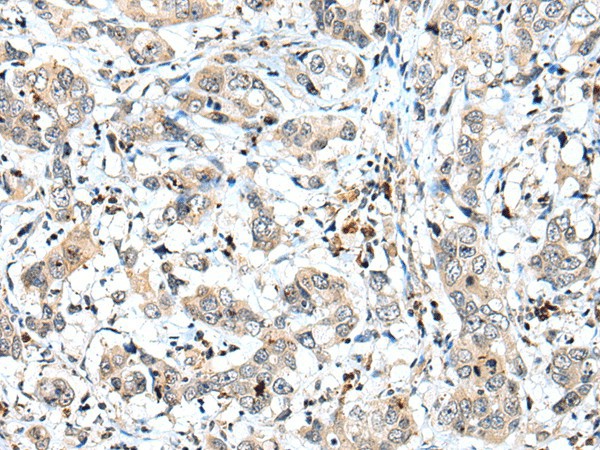 Immunohistochemistry of paraffin-embedded Human breast cancer tissue  using SPCS2 Polyclonal Antibody at dilution of 1:40(?200)