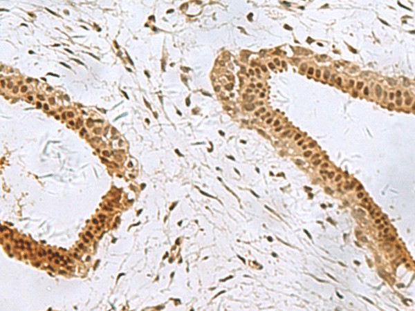 Immunohistochemistry of paraffin-embedded Human breast cancer tissue  using PCBD1 Polyclonal Antibody at dilution of 1:90(?200)