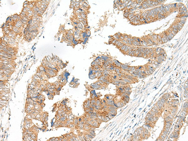 Immunohistochemistry of paraffin-embedded Human colorectal cancer tissue  using SLC6A9 Polyclonal Antibody at dilution of 1:25(?200)