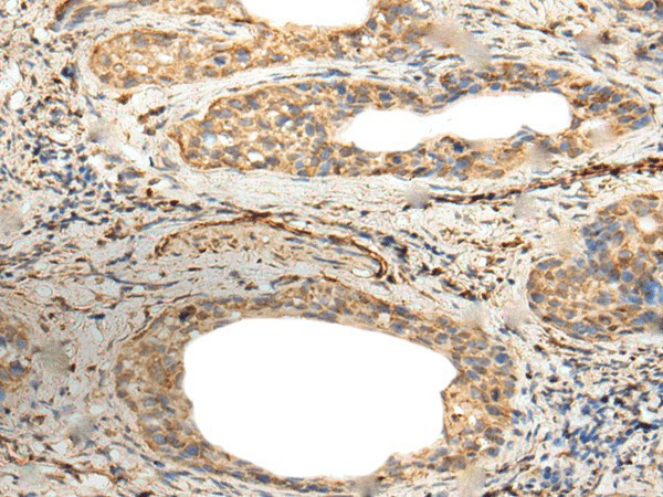 Immunohistochemistry of paraffin-embedded Human cervical cancer tissue  using ZNF8 Polyclonal Antibody at dilution of 1:40(?200)