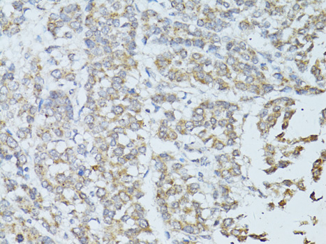 Immunohistochemistry of paraffin-embedded Human colon carcinoma using TEFM Polyclonal Antibody at dilution of 1:100 (40x lens).