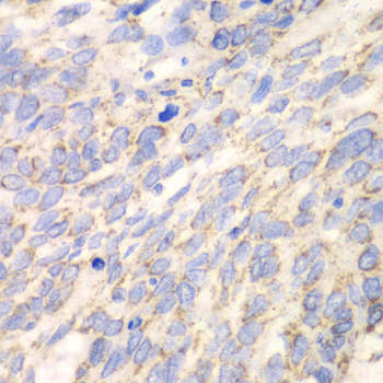 Immunohistochemistry of paraffin-embedded Human esophageal cancer using DLD Polyclonal Antibody at dilution of 1:100 (40x lens).