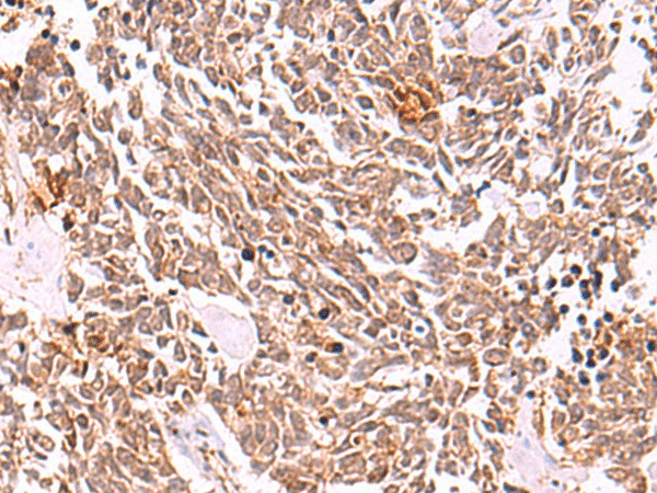 Immunohistochemistry of paraffin-embedded Human lung cancer tissue  using COPS3 Polyclonal Antibody at dilution of 1:50(?200)