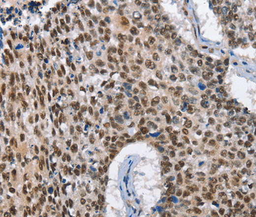 Immunohistochemistry of paraffin-embedded Human lung cancer tissue using GNRH1 Polyclonal Antibody at dilution 1:65