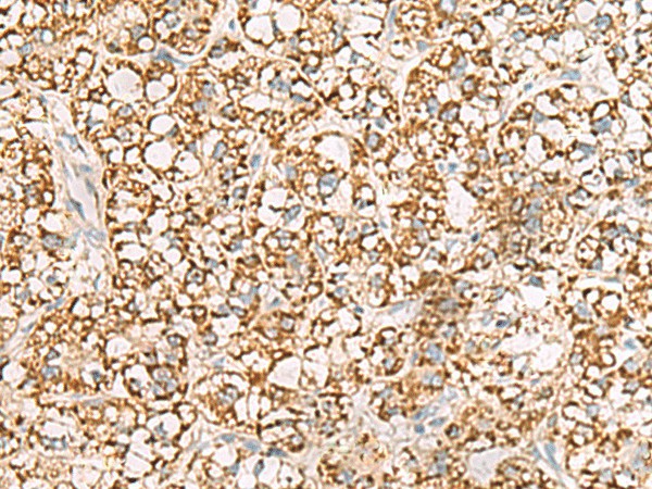 Immunohistochemistry of paraffin-embedded Human liver cancer tissue  using ISOC2 Polyclonal Antibody at dilution of 1:95(?200)