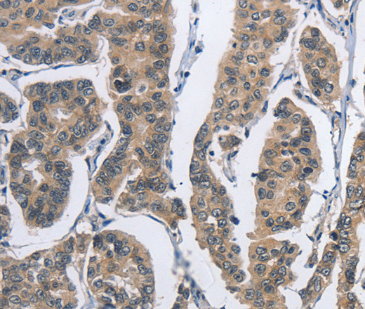 Immunohistochemistry of paraffin-embedded Human breast cancer tissue using DSG2 Polyclonal Antibody at dilution 1:50