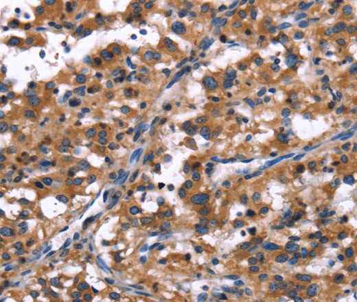 Immunohistochemistry of paraffin-embedded Human thyroid cancer tissue using R3HCC1L Polyclonal Antibody at dilution 1:40